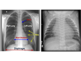 NORMAL HEART

VSD - HYPERTROPHY

 