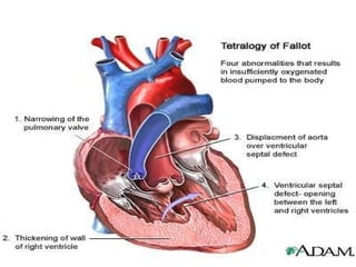 TETRALOGY OF FALLOT

 