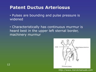 Patent Ductus Arteriosus
• Pulses are bounding and pulse pressure is
widened
• Characteristically has continuous murmur is
heard best in the upper left sternal border,
machinery murmur
12
http://www.merckmanuals.com
 