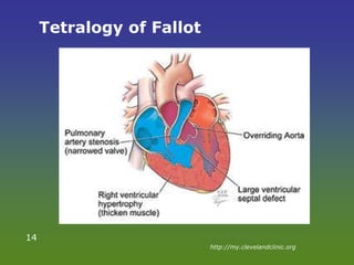 Tetralogy of Fallot
14
http://my.clevelandclinic.org
 