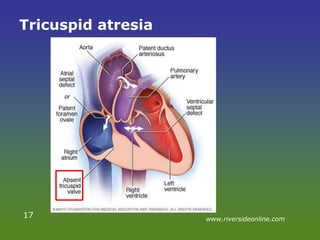 Tricuspid atresia
17 www.riversideonline.com
 