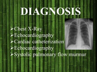 Chest X-Ray
Echocardiography
Cardiac catheterization
Echocardiography
Systolic pulmonary flow murmur
DIAGNOSIS
 