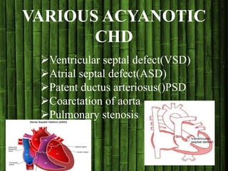 VARIOUS ACYANOTIC
CHD
Ventricular septal defect(VSD)
Atrial septal defect(ASD)
Patent ductus arteriosus()PSD
Coarctation of aorta
Pulmonary stenosis
 