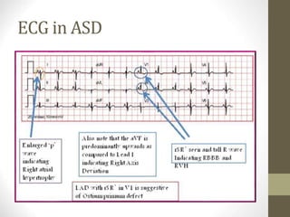 ECG in ASD
 
