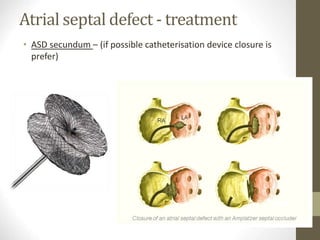 Atrial septal defect - treatment
• ASD secundum – (if possible catheterisation device closure is
prefer)
 