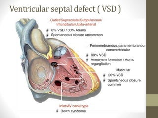 Ventricular septal defect ( VSD )
 