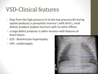 VSD-Clinical features
• Flow from the high-pressure LV to the low-pressure RV during
systole produces a pansystolic murmur ( with thrill ), small
defects produce loudest murmurs with no other effects.
• a large defect produces a softer murmur with features of
heart failure.
• ECG : Biventricular hypertrophy.
• CXR : cardiomegaly
 