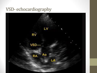 VSD- echocardiography
 