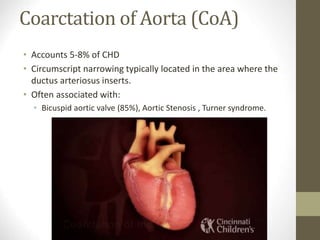 Coarctation of Aorta (CoA)
• Accounts 5-8% of CHD
• Circumscript narrowing typically located in the area where the
ductus arteriosus inserts.
• Often associated with:
• Bicuspid aortic valve (85%), Aortic Stenosis , Turner syndrome.
 