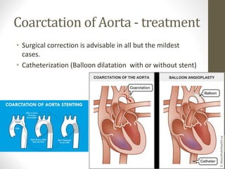 Coarctation of Aorta - treatment
• Surgical correction is advisable in all but the mildest
cases.
• Catheterization (Balloon dilatation with or without stent)
 