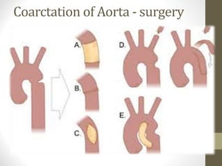 Coarctation of Aorta - surgery
 