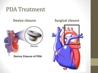 PDA Treatment
Device closure Surgical closure
 