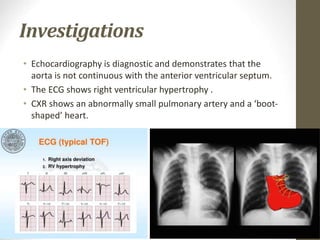 Investigations
• Echocardiography is diagnostic and demonstrates that the
aorta is not continuous with the anterior ventricular septum.
• The ECG shows right ventricular hypertrophy .
• CXR shows an abnormally small pulmonary artery and a ‘boot-
shaped’ heart.
 