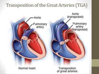 Transposition of the Great Arteries (TGA)
 