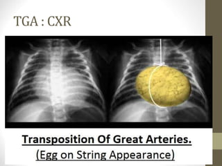 TGA : CXR
 