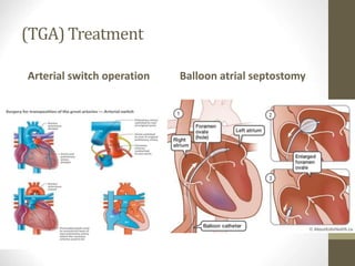 (TGA) Treatment
Arterial switch operation Balloon atrial septostomy
 