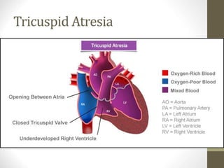 Tricuspid Atresia
 