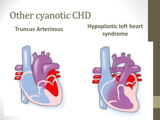 Other cyanotic CHD
Truncus Arteriosus Hypoplastic left heart
syndrome
 