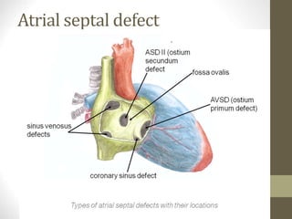 Atrial septal defect
 