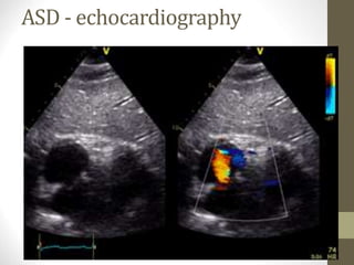 ASD - echocardiography
 