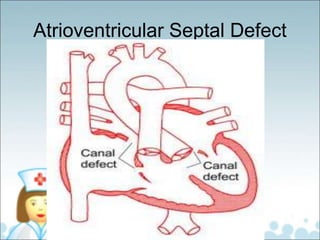 Atrioventricular Septal Defect
 