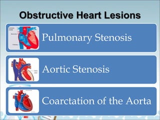 Obstructive Heart Lesions
Pulmonary Stenosis
Aortic Stenosis
Coarctation of the Aorta
 