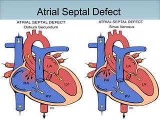 Atrial Septal Defect
 