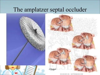 The amplatzer septal occluder
 