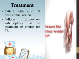 Treatment
• Patient with mild PS
need annual review
• Balloon pulmonary
valvuloplasty is the
treatment of choice for
PS.
 