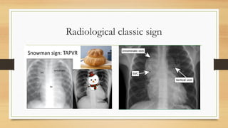 Spring Sign Ct Scan CONGENITAL HEART DISEASE 2.2.pptx for radiology | PPTX