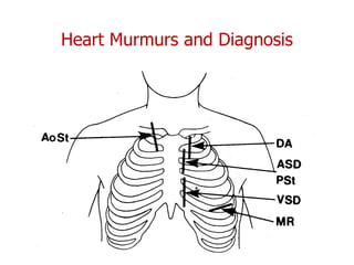 Heart Murmurs and Diagnosis
 