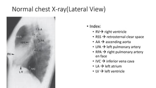 Congenital heart disease and vascular abnormality(x-ray findings) | PDF