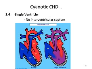 Cyanotic CHD…
2.4   Single Ventricle
            - No interventricular septum




                                           83
 
