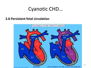 Cyanotic CHD…
2.6 Persistent fetal circulation




                                   87
 