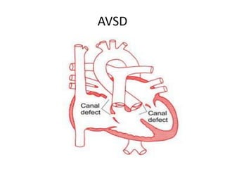 AVSD
 