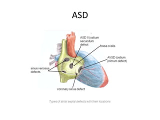 ASD
 