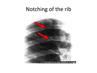 Notching of the rib
 
