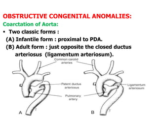 OBSTRUCTIVE CONGENITAL ANOMALIES:
Coarctation of Aorta:
 Two classic forms :
(A) Infantile form : proximal to PDA.
(B) Adult form : just opposite the closed ductus
arteriosus (ligamentum arteriosum).
 