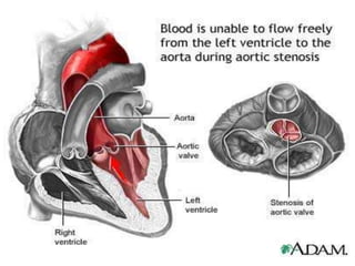 Congenital heart diseases 1