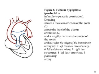 Congenital Heart Diseases Slide 12