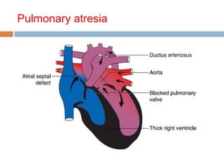 Congenital heart diseases