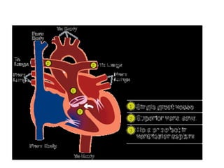 TETRALOGY OF FALLOT
Cyanotic congenital heart malformation
comprising:
 infundibular pulmonary stenosis,
 conoventricula...