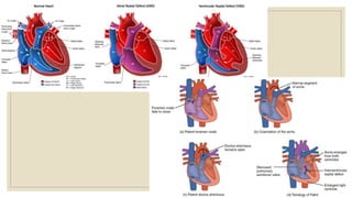 Congenital heart diseases | PPTX