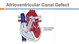 Congenital heart diseases | PPTX