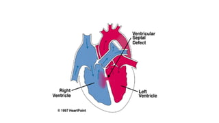 Comprehensive Overview of Congenital Heart Diseases in Pediatrics | PPTX
