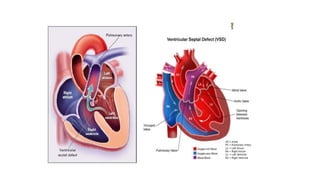 Comprehensive Overview of Congenital Heart Diseases in Pediatrics | PPTX
