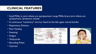 CLINICAL FEATURES
• Small PDAs in term infants are asymptomatic. Large PDAs & pre term infants are
symptomatic. Symptoms include
• A continuous "machinery" murmur heard at the left upper sternal border.
• Respiratory Distress
• Poor Feeding
• Sweating
• Fatigue
• Tachycardia
• Bounding Pulses
• Cyanosis
 
