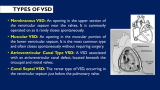 TYPES OFVSD
• Membranous VSD: An opening in the upper section of
the ventricular septum near the valves. It is commonly
operated on as it rarely closes spontaneously.
• Muscular VSD: An opening in the muscular portion of
the lower ventricular septum. It is the most common type
and often closes spontaneously without requiring surgery.
• Atrioventricular Canal Type VSD: A VSD associated
with an atrioventricular canal defect, located beneath the
tricuspid and mitral valves.
• Conal Septal VSD: The rarest type of VSD, occurring in
the ventricular septum just below the pulmonary valve.
 