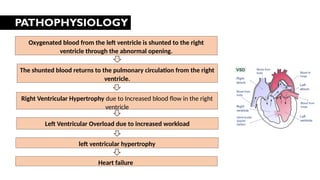PATHOPHYSIOLOGY
Oxygenated blood from the left ventricle is shunted to the right
ventricle through the abnormal opening.
The shunted blood returns to the pulmonary circulation from the right
ventricle.
Left Ventricular Overload due to increased workload
Right Ventricular Hypertrophy due to Increased blood flow in the right
ventricle
left ventricular hypertrophy
Heart failure
[
 