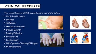 CLINICAL FEATURES
The clinical features ofVSD depend on the size of the defect.
• Harsh Loud Murmur
• Dyspnea
• Tachypnea
• Exercise Intolerance
• Delayed Growth
• Feeding Difficulty
• Recurrent RI
• Cardiomegaly
• Mild Cyanosis, Clubbing Of Fingers
• RV Hypertrophy
 
